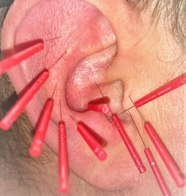 Naturheilpraxis Daniel Brunner Berlin, Ohrakupunktur