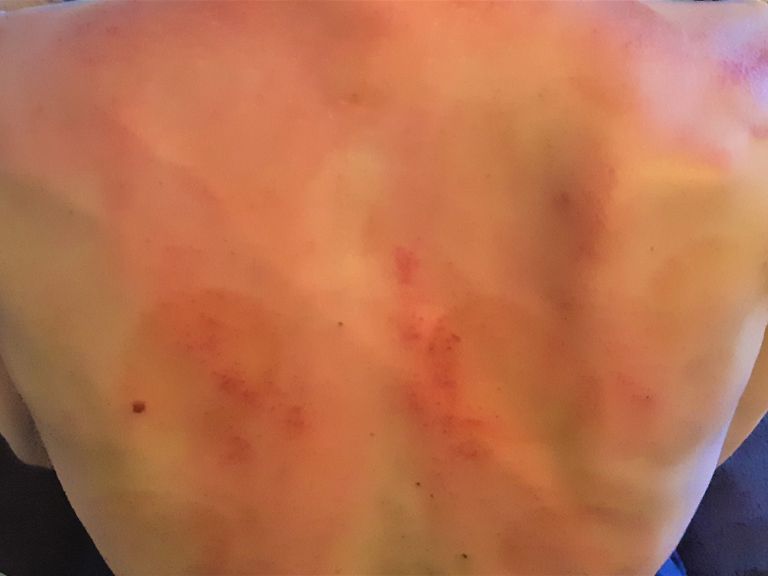 Naturheilpraxis Daniel Brunner, Berlin-Moabit, Traditionelle Chinesische Medizin, Gua Sha