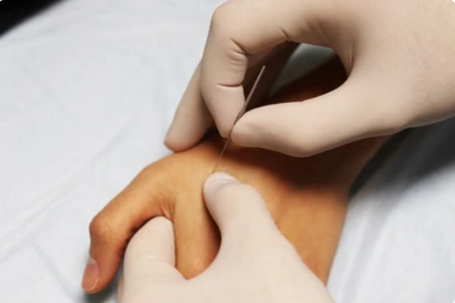 Dry Needling, Berlin Moabit, HP Brunner, Naturheilpraxis Daniel Brunner