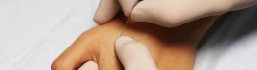 Dry Needling