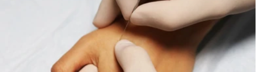 Dry Needling in Berlin in der Naturhailpraxis Daniel Brunner