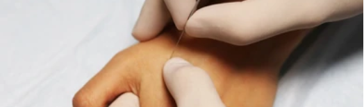 Dry Needling - Naturheilpraxis Daniel Brunner
